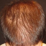 Hair Loss Treatments Hair Loss Treatments By Trichologist Carolyn Evans-Frost I.A.T.
