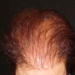 Hair Loss Treatments Hair Loss Treatments By Trichologist Carolyn Evans-Frost I.A.T.