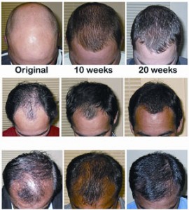 Can Laser Hair Therapy Really Help My Thinning Hair? By Hair Loss Treatments - Call Us On 07 3229 3242
