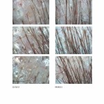 Sandy Microscopic Results Hair Loss Treatments
