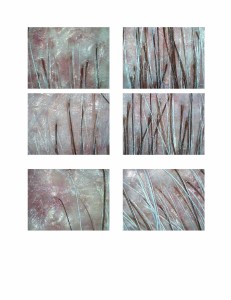 Never Too Late For Hair Loss Treatments Before and After Images Microscopic