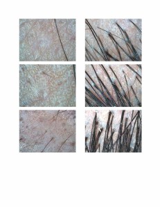 Dee's Alopecia Areata Hair Loss Treatments Before and After Images Microscopic