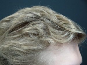 Young Men’s Hair Loss Treatment Success Story After