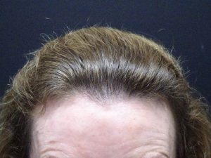 Women’s Hair Thinning Treatment Story After
