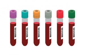 Blood Tests for Autoimmune with Trichologist Brisbane