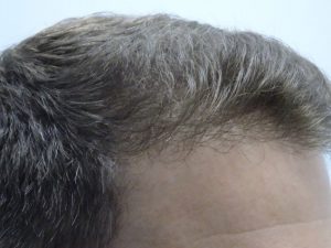 Men’s Story - Hair Loss Treatment After