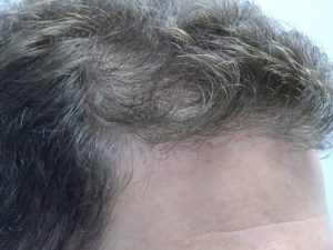 Men’s Story - Hair Loss Treatment Before