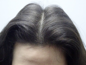 Female Hair Thinning Treatment Story with Absolique Trichologist After