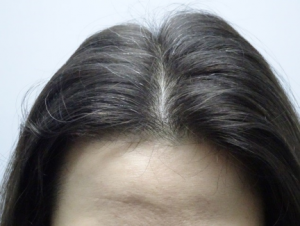 Female Hair Thinning Treatment Story with Absolique Trichologist Before