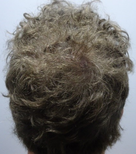 Male Hair Thinning Treatment Story with Absolique Trichologist After