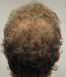 Male Hair Thinning Treatment Story with Absolique Trichologist Before