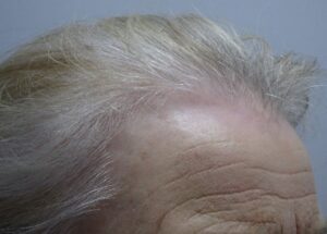Female Hair Loss Treatment Success Story Before