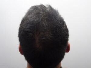 Male Hair Loss Treatment with PRP After