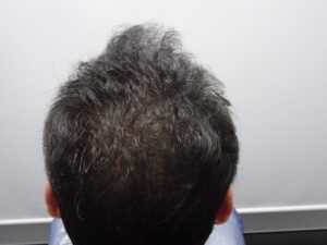 Male Hair Loss Treatment with PRP Before
