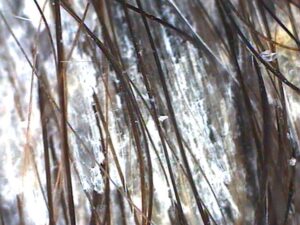 Scalp Treatment with Absolique Trichologist Before