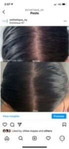 PRP treatment before and after