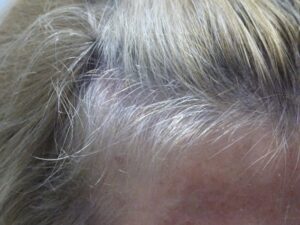 Female Hair Loss Treatment Story After