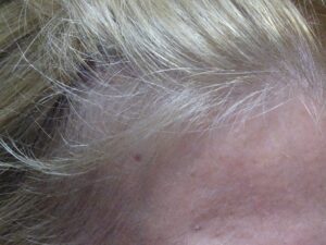 Female Hair Loss Treatment Story Before