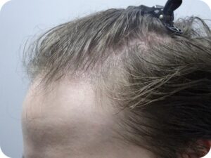 Men’s Scalp Treatment with Side Benefit of Hair Growth Before