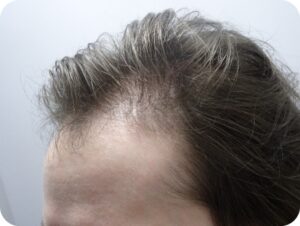 Men’s Scalp Treatment with Side Benefit of Hair Growth After