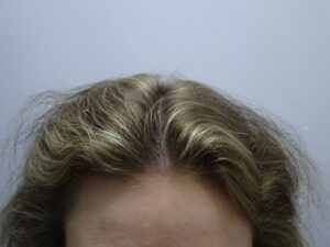 Female Hair Loss Treatment Story and Results After