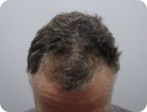 Alopecia Areata Story After
