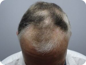 Alopecia Areata Story Before