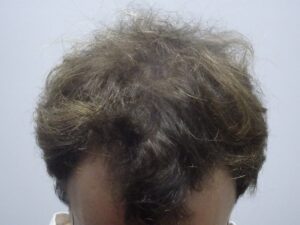 Male Hair Loss Treatment Story and Results After