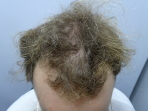 Male Hair Loss Treatment Story and Results Before