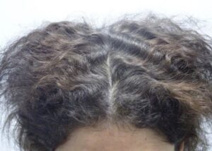 Low Ferritin Hair Loss Story After