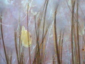 Scalp Treatment In Clinic and Scalp Cleanser at Home Before