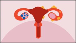 Hormonal Hair (Thinning) Loss - PCOS, PCOD, Endometriosis, Adenomyosis