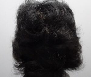 Alopecia Areata Super Model Story After
