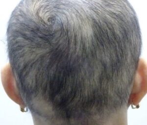 Alopecia Areata Super Model Story Before
