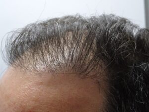 Post Hair Transplant Hair Thinning Treatment with PRP After