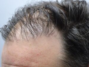 Post Hair Transplant Hair Thinning Treatment with PRP Before