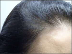 Female Hair Loss Treatment Before