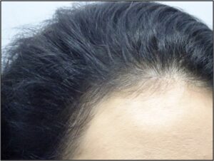 Female Hair Loss Treatment After