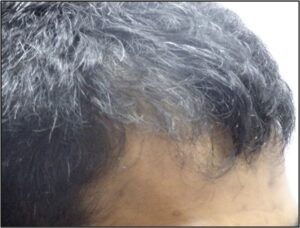 Results, Men’s Maintenance Hair Thinning Treatment After