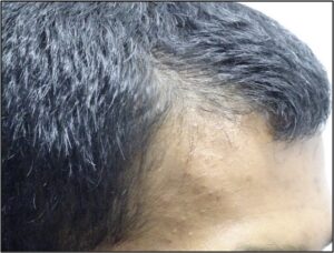 Results, Men’s Maintenance Hair Thinning Treatment Before