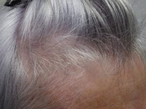Women’s Hair Loss and Ageing After