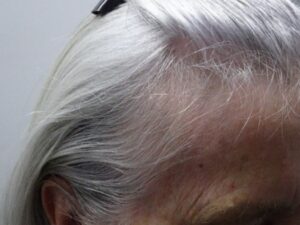 Women’s Hair Loss and Ageing Before