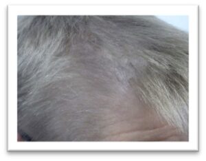 Men’s Hair Growth Treatment Results – HRP SP55 Silver Kit Before