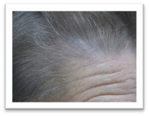Men’s Hair Growth Treatment Results – HRP SP55 Silver Kit 1 month