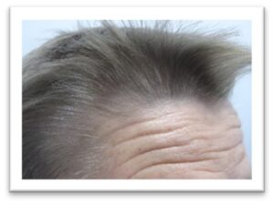 Men’s Hair Growth Treatment Results – HRP SP55 Silver Kit After