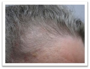 Women’s Hair Thinning and Scalp Treatment Results Before