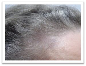 Women’s Hair Thinning and Scalp Treatment Results After