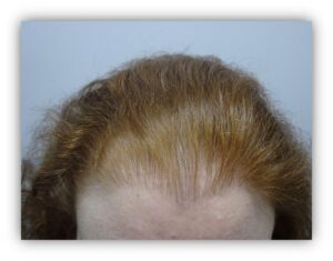 Female Pattern Hair Thinning Story After