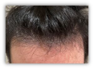 New Hair Growth Treatment at Absolique After