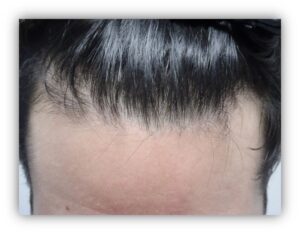 New Hair Growth Treatment at Absolique Before